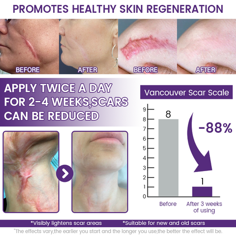 Timilk ReGenScar Stem Cell Scar Gel