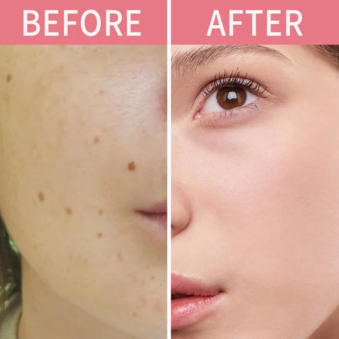 Timilk Wart & Mole Removal Spray