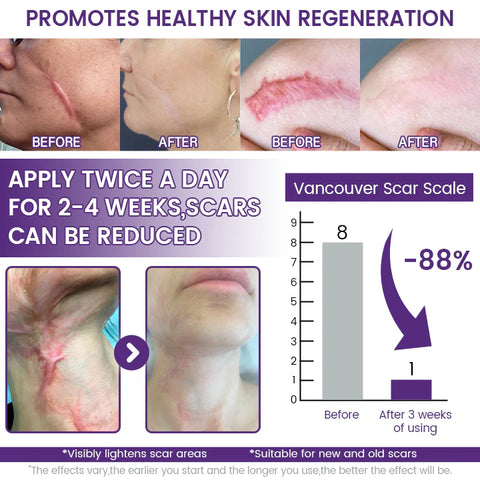 Timilk ReGenScar Stem Cell Scar Gel